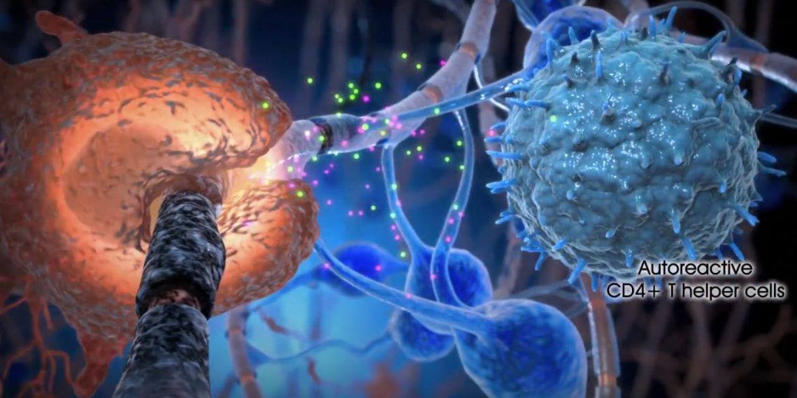 Hari Multiple Sclerosis Sedunia: Menyoroti Penyakit yang Mempengaruhi Sistem Saraf Pusat